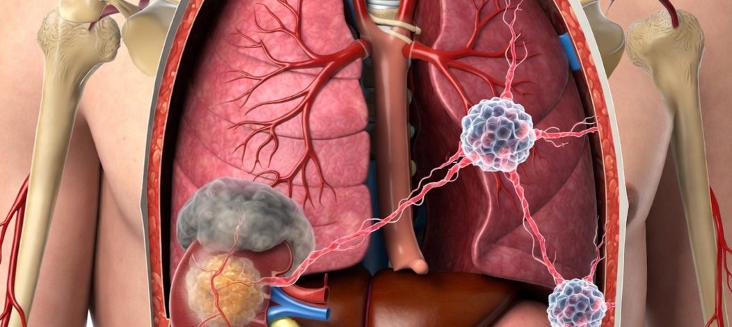 Metastatic Kidney Cancer and What It Entails