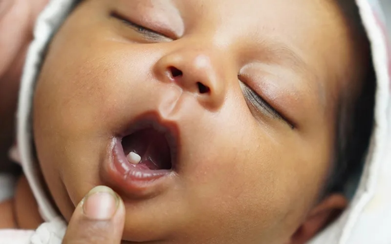 The Medical Truth About Babies Born With Teeth