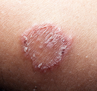 What Causes the Itchy Red Ring on Your Skin and How to Beat It